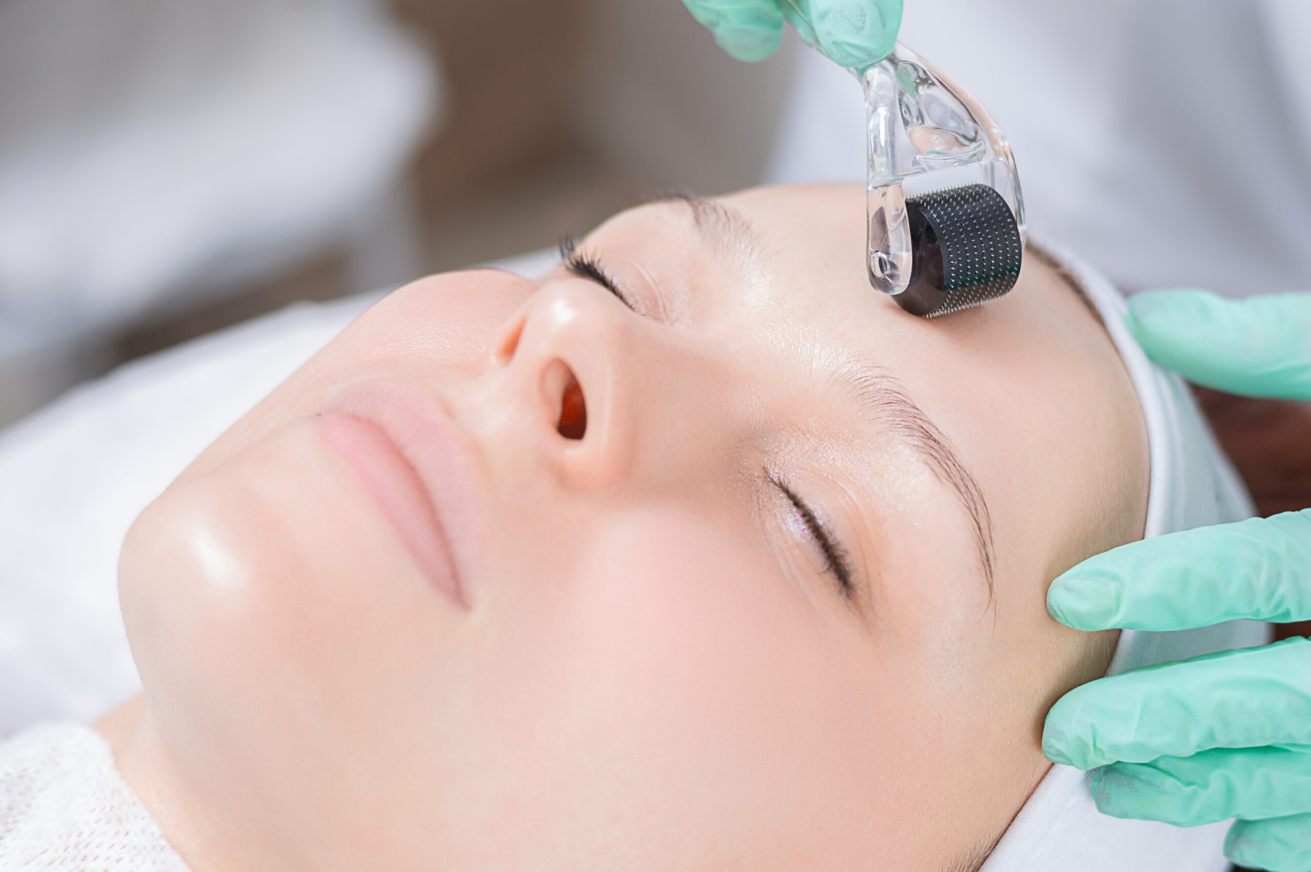 Microagulhamento em Clínica de Estética em Salvador