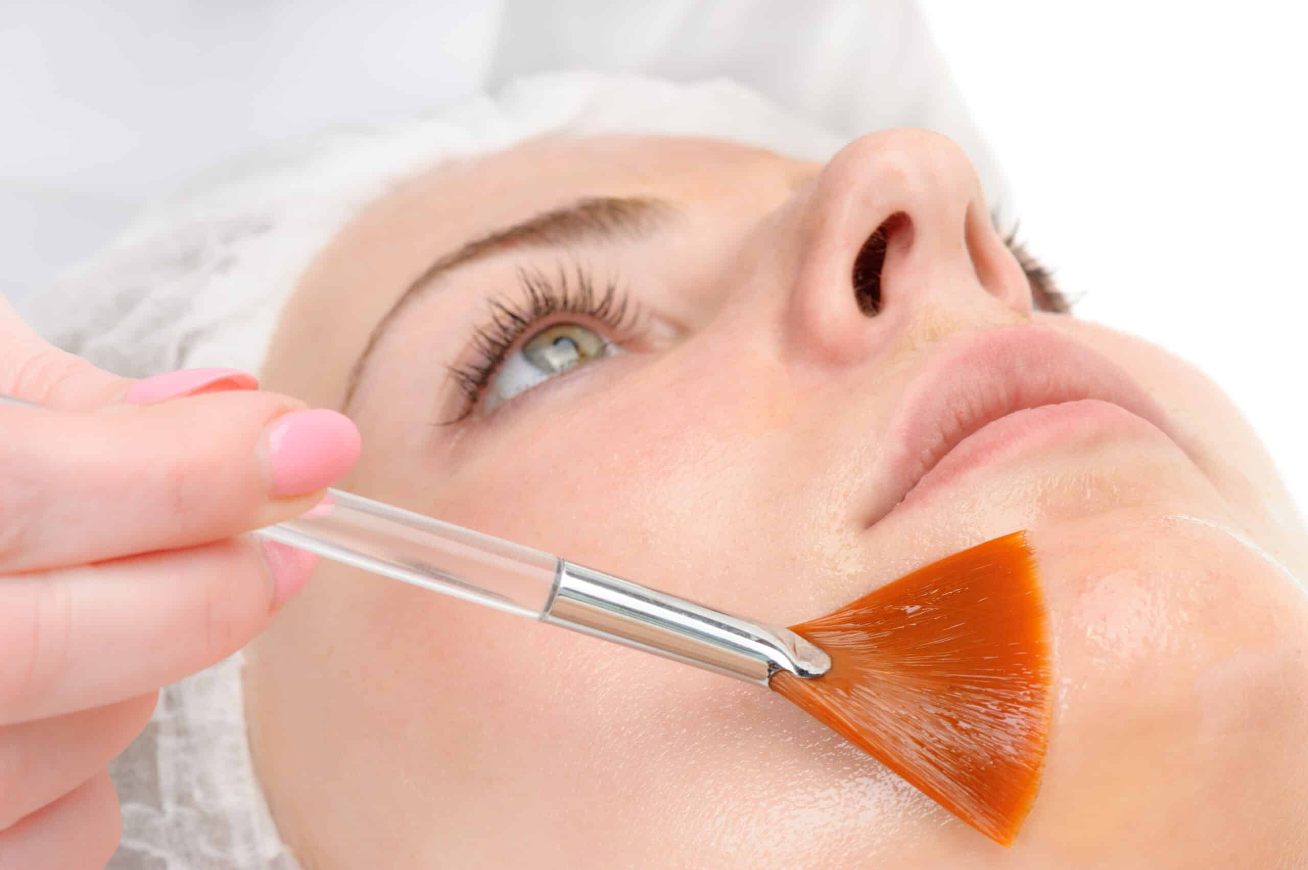 Peeling Químico em Clínica de Estética em Salvador